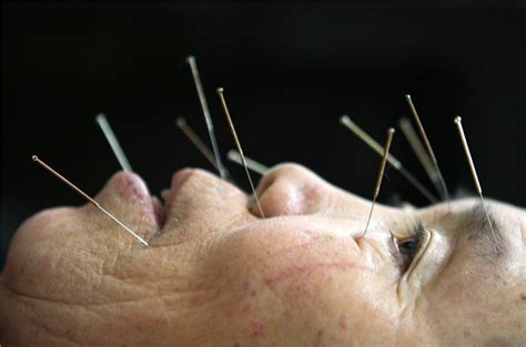 Why Was Acupuncture Invented In Ancient China At Ashley Miller Blog