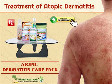 Treatment of Atopic Dermatitis with Natural Herbal Remedies