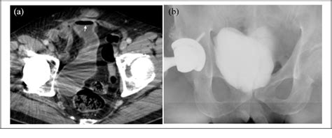 Figure 2 From Use Of Ileal Bypass In The Surgical Management Of Two Rare Cases Of Ileal