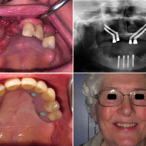 Pdf Primary Vs Secondary Zygomatic Implant Placement In Patientswith