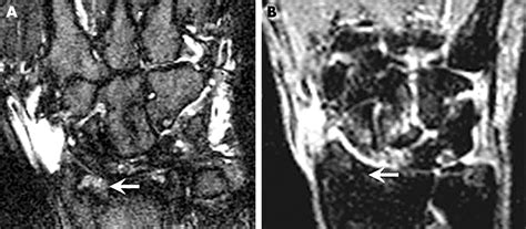 Optimised Low Cost Low Field Dedicated Extremity Mri Is Highly Specific And Sensitive For