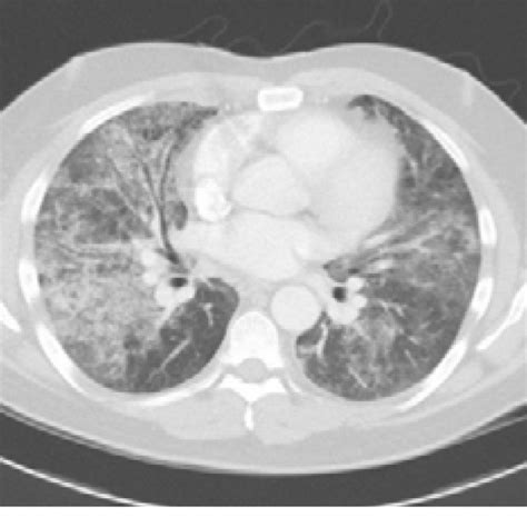 Diffuse Ground Glass Opacities Thickening Of Interlobular Septa And Download Scientific