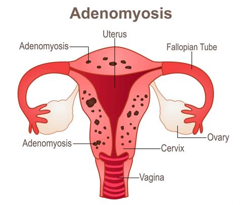 Adenomyosis Specialist Brisbane Eve Health