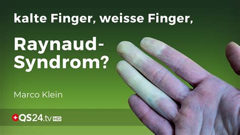 Raynaud Syndrom kalte Hände und Durchblutungsstörung Kleinsche