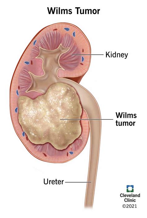 Understanding The Diagnosis And Treatment Of Wilms Tumor Ask The