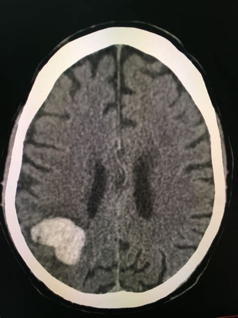 The Clinical Importance Of White Matter Hyperintensities On Brain