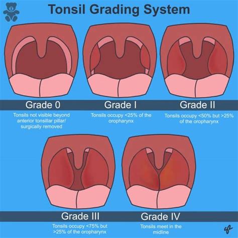 Tonsillitis Clinical Features Management Teachmepaediatrics