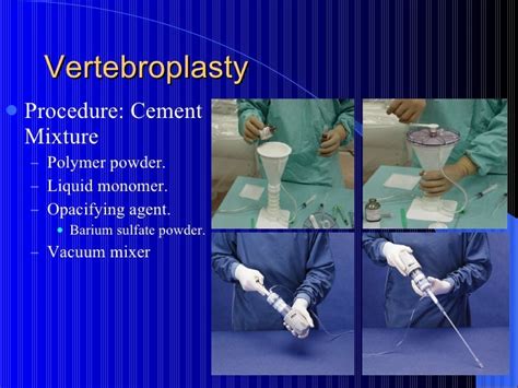 Vertebroplasty Grand Rounds