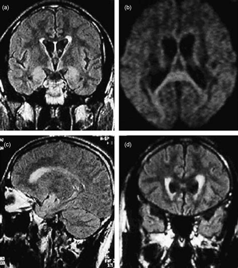 A 42 Year Old Man With Neurosyphilis Who Had General Paresis With