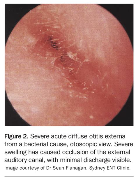 Aural Discharge Types Causes And Treatment Medicine Today