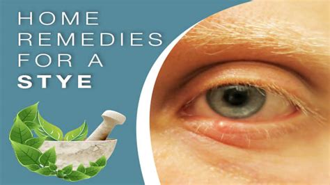 How To Get Rid Of A Stye Safe And Effective Home Remedies