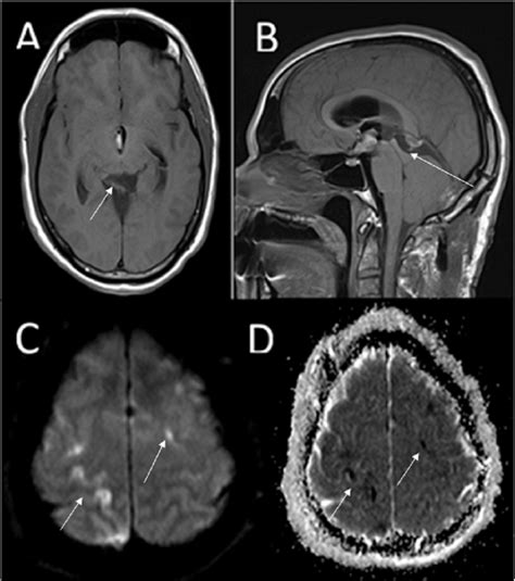 Post Operative Magnetic Resonance Imaging Mri A Axial T Weighted