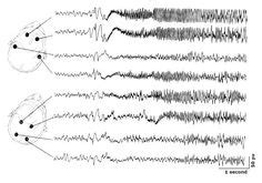 Tonic-clonic (grand mal) Seizure