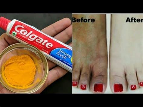 Magical Remedy To Lighten Dark Feet And Hands