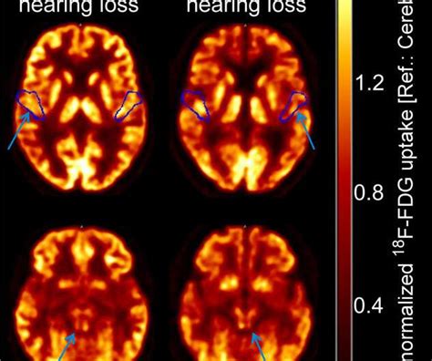 High Resolution Pet Ct Assesses Brain Stem Function In Patients With