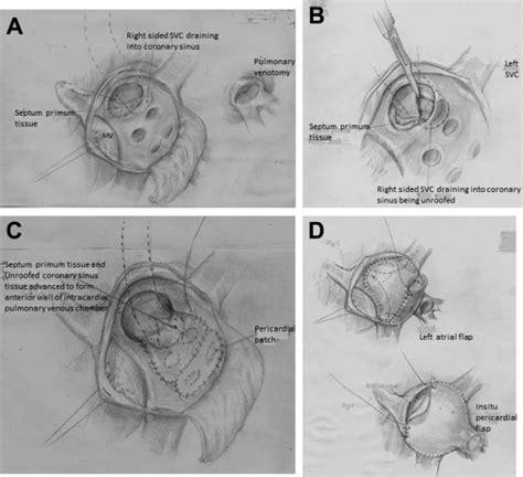 Modified Senning Procedure For Correction Of Atrioventricular