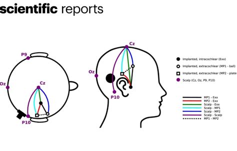 Des chercheurs enregistrent un électroencéphalogramme via un implant