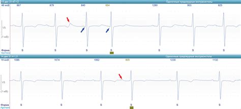 Atrial Ectopic Beats With Conduction Through The Slow A And Fast B Download Scientific