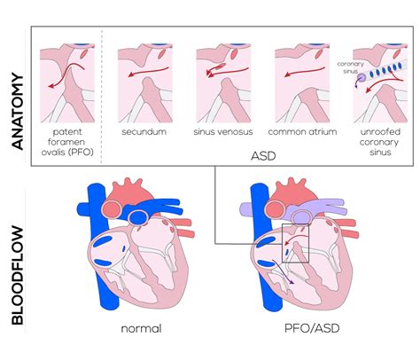 Congenital Defects Tutorial - Congenital Heart Defects | Atlas of Human Cardiac Anatomy