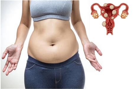 fibroids symptoms weight gain | Public Health