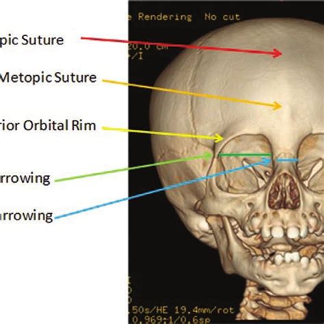 A 3d Ct Scan Of A Partially Fused Metopic Suture In A 8 Month Old