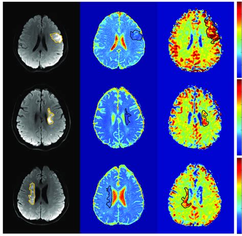 DWI ADC Maps And K Ex Maps Of Representative Cases Of Acute