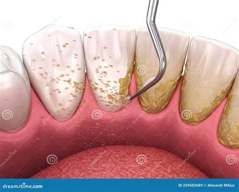 Oral Hygiene Scaling And Root Planing Conventional Periodontal Therapy