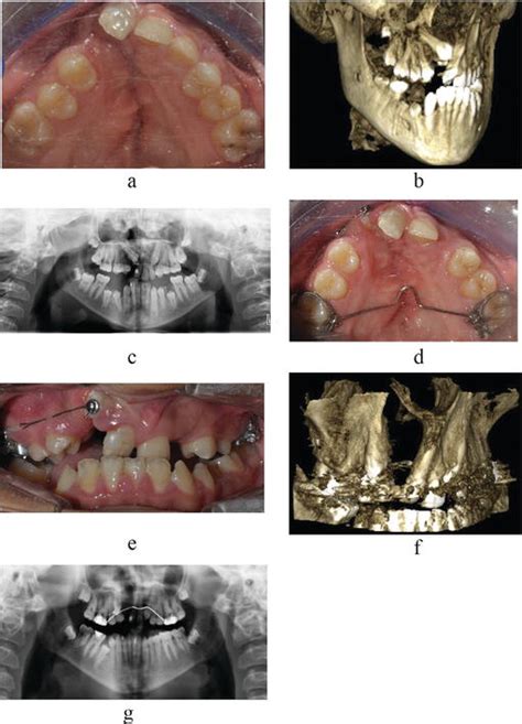 Alveolar Bone Graft