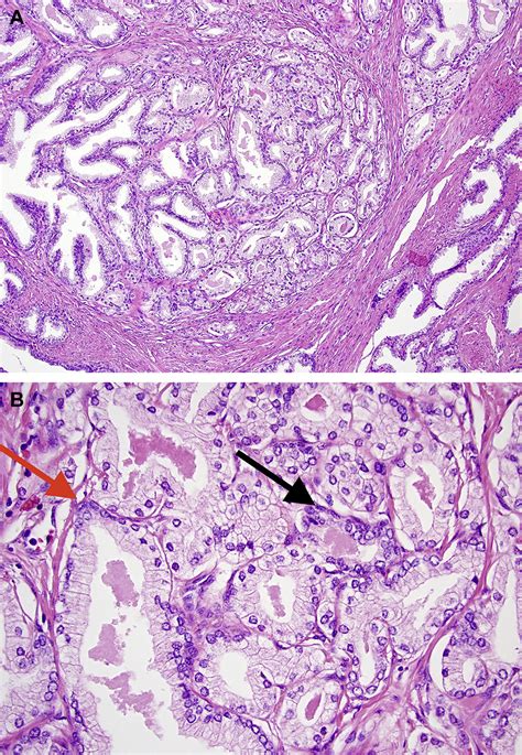 Updates In Benign Lesions Of The Genitourinary Tract Surgical Pathology Clinics