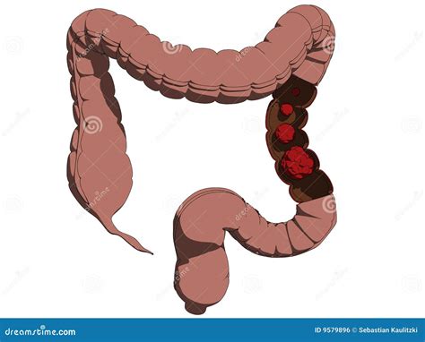 Colon Cancer Stock Vector Illustration Of Colon Health 9579896