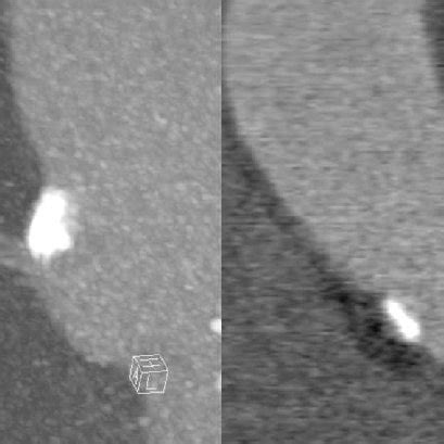 Calcification of aortic valve leaflets shown in multi-slice computed ...