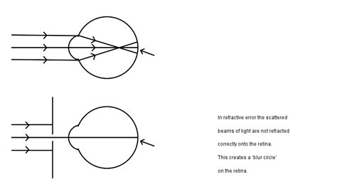 Pinhole Eyewear Natural Vision Therapy