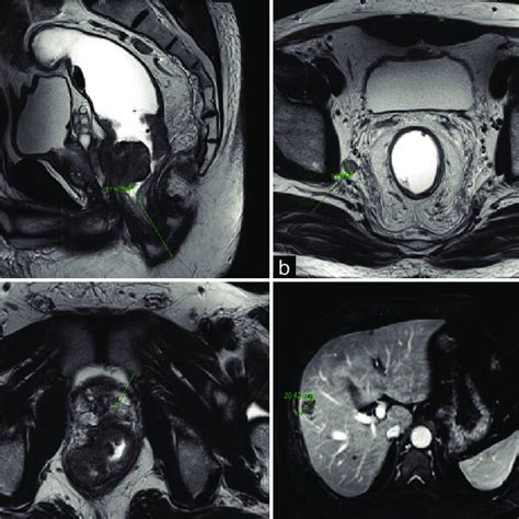 Pelvic Magnetic Resonance Imaging And Liver Magnetic Resonance Imaging