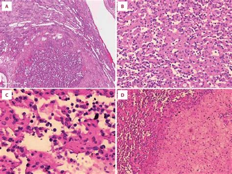 Histopathology Of Renal Anastomosing Hemangioma Hande A Low Power