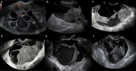 Imaging In Gynecological Disease 23 Clinical And Ultrasound