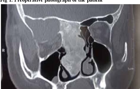 Figure 1 From Skull Base Fibrous Dysplasia Endonasal Endoscopic Approach A Case Report