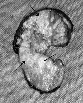 Xanthogranulomatous Pyelonephritis Presenting As A Pseudotumor In A