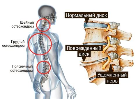 Остеохондроз: к какому врачу обращаться. Причины и лечение остеохондроза.