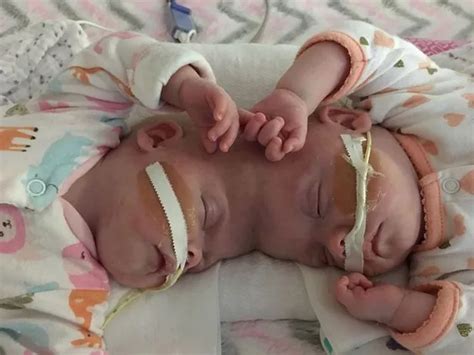 Rare Conjoined Twins Born Fused By Their Skulls Successfully Separated