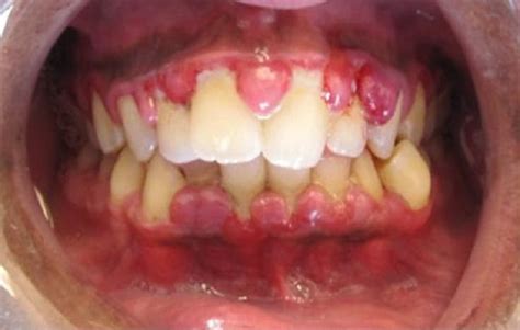 Diagnosis Gingivitis Alomedika