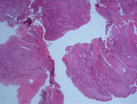 Lesional Tissue Composed Of Spindle Cells Arranged In Short Fascicles