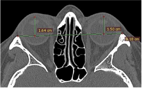 Natural Progression Of Bilateral Maxillary Silent Sinus Syndrome A Metachronous Case Report