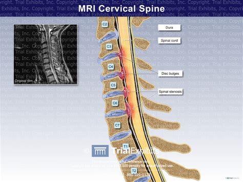 Mri Cervical Spine Trialexhibits Inc