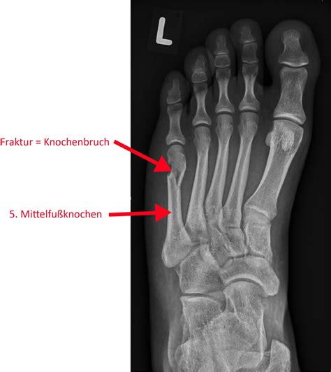 Fraktur 5 Mittelfußknochen OGAM Orthopädie