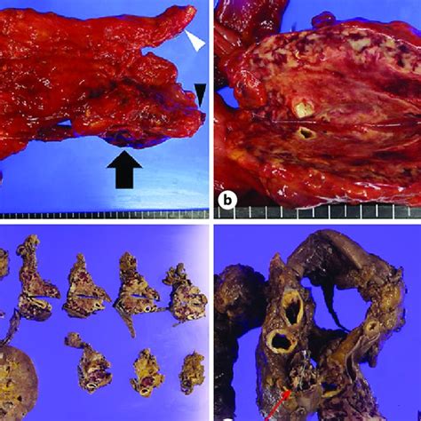 Gross Findings Of The Tissue Resected By Autopsy A Tumor And