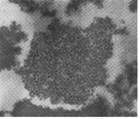 Figure From Immuno Electron Microscopy Of Hepatitis B Antigen In