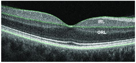 Representative Optical Coherence Tomography Image Of An Eye In A