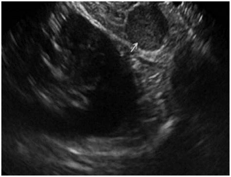 Eus Image Showed A Small Homogeneous Hypoechoic Lesion In Pancreas Tail Download Scientific