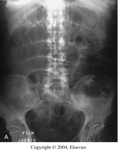 ACUTE Abdomen ACUTE ABDO Flashcards Quizlet