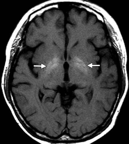 Differential Diagnosis For Bilateral Abnormalities Of The Basal Ganglia